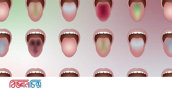 জিহ্বা দেখেই রোগ বলে দেবে এআই