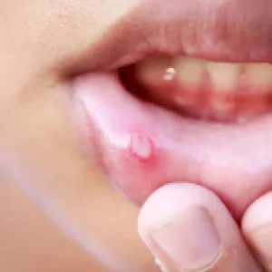 মুখের ভেতরে ঘা হয় যেসব কারণে