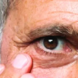 গ্লুকোমা শনাক্ত এবং এ রোগের চিকিৎসা