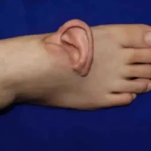 প্রথমবারের মতো বিচ্ছিন্ন কান পায়ে প্রতিস্থাপন, আবার যথাস্থানে স্থাপন